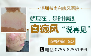 深圳白癜风医院讲解老年白斑的症状有哪些