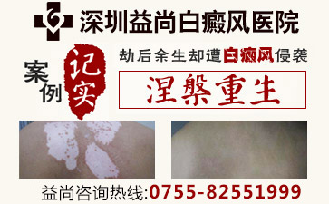 深圳宝安区治疗白斑病费用白癜风发展到晚期